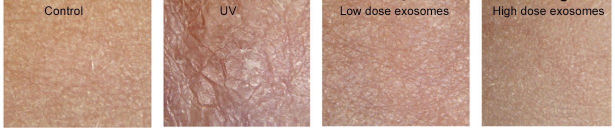 Exosomes prevent UV damage in animal studies