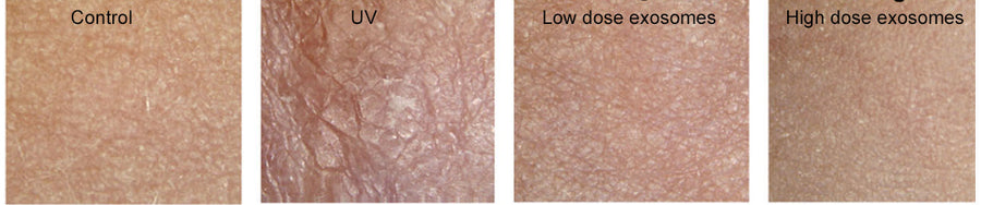 Exosomes prevent UV damage in animal studies