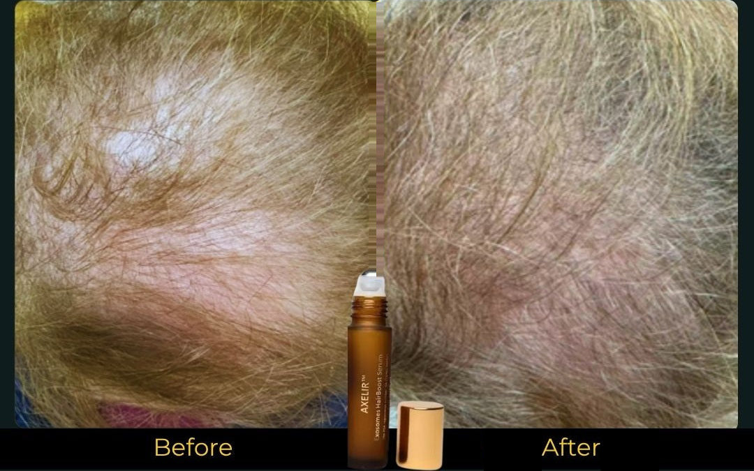 AlaR7 HairBoost before and after fuller-looking hair results: scalp coverage