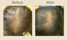 Before and after comparison of a female who is unresponsive to Minoxidil, 1 month after using AXELIR Exosomes HairBoost Serum